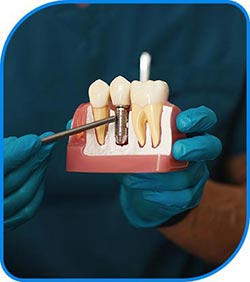 Implants Near Me in Norwalk, CA