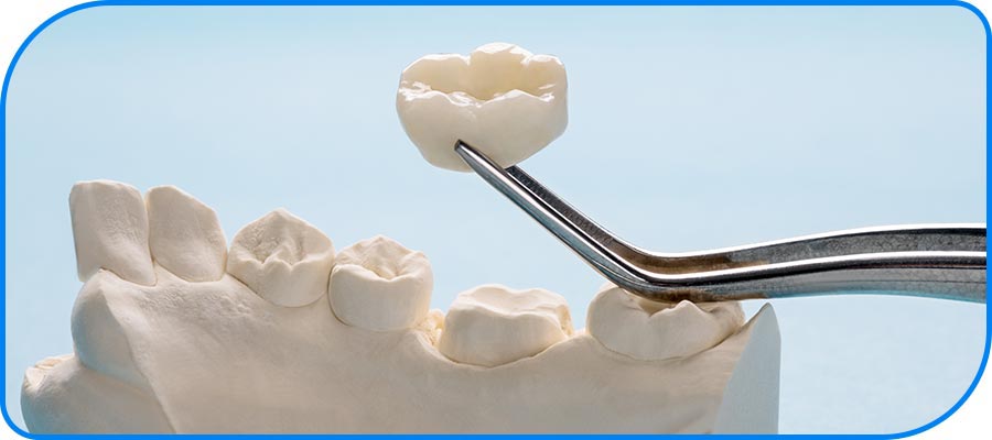 FAQs About - Same-Day Zirconia Crowns Near Me in Norwalk, CA FAQs About - Same-Day Zirconia Crowns Near Me in Norwalk, CA