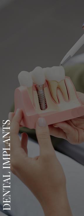 Dental Implants Near Me in Norwalk, CA Dental Implants Near Me in Norwalk, CA