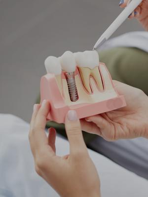Dental Implants Near Me in Norwalk, CA Dental Implants Near Me in Norwalk, CA
