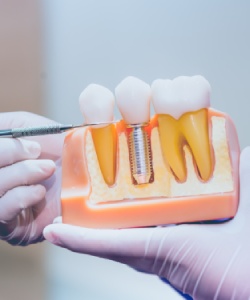 Dental Implants Near Me in Norwalk, CA